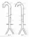 Fig. 22 - Intra-aortic balloon apparatus, assist devices and methods for improving flow, counterpulsation and haemodynamics