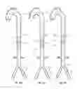 Fig. 23 - Intra-aortic balloon apparatus, assist devices and methods for improving flow, counterpulsation and haemodynamics