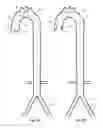 Fig. 30 - Intra-aortic balloon apparatus, assist devices and methods for improving flow, counterpulsation and haemodynamics