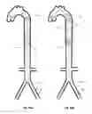 Fig. 33 - Intra-aortic balloon apparatus, assist devices and methods for improving flow, counterpulsation and haemodynamics