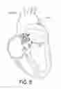 Fig. 06 - Ventricular assist device and method