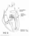 Fig. 07 - Ventricular assist device and method