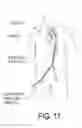 Fig. 09 - Ventricular assist device and method