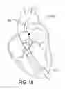 Fig. 12 - Ventricular assist device and method
