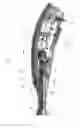 Fig. 03 - IRRIGATOR FOR WASHING WHILE SURGERY OPERATION