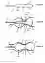 Fig. 02 - Positionable valvuloplasty catheter