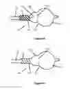 Fig. 05 - Positionable valvuloplasty catheter