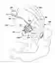 Fig. 01 - Convection enhanced delivery device and system