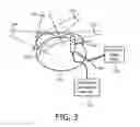 Fig. 04 - Real-time quantification of skin burns in external beam radiation therapy