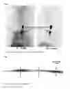 Fig. 07 - Compounds for binding to the platelet specific glycoprotein IIb/IIIa and their use for imaging of thrombi