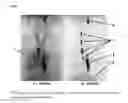 Fig. 08 - Compounds for binding to the platelet specific glycoprotein IIb/IIIa and their use for imaging of thrombi