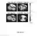 Fig. 14 - METHODS AND COMPOSITIONS FOR THE DIAGNOSIS, PROGNOSIS AND TREATMENT OF BRAIN METASTASIS