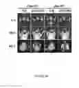 Fig. 19 - METHODS AND COMPOSITIONS FOR THE DIAGNOSIS, PROGNOSIS AND TREATMENT OF BRAIN METASTASIS