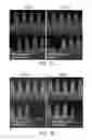 Fig. 09 - Internal plasma grid for semiconductor fabrication