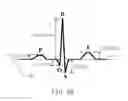 Fig. 50 - ELECTROCARDIOGRAPHY SIGNAL EXTRACTION METHOD
