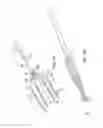 Fig. 10 - Catheter with high density electrode spine array
