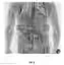 Fig. 09 - Multi-beam stereoscopic X-ray body scanner