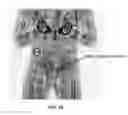 Fig. 13 - Multi-beam stereoscopic X-ray body scanner