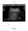 Fig. 06 - SYSTEM AND METHOD FOR MAPPING ULTRASOUND SHEAR WAVE ELASTOGRAPHY MEASUREMENTS