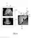 Fig. 10 - SYSTEM AND METHOD FOR MAPPING ULTRASOUND SHEAR WAVE ELASTOGRAPHY MEASUREMENTS