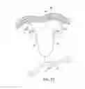 Fig. 21 - System for intra-abdominally moving an organ