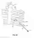 Fig. 07 - METHOD AND APPARATUS FOR TRANSAPICAL ACCESS AND CLOSURE