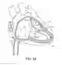 Fig. 07 - Delivery system assemblies for implantable medical devices