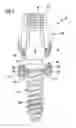 Fig. 06 - Pedicle screw system and spinal stabilization system