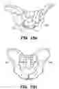 Fig. 23 - Method and apparatus for joint fusion