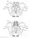 Fig. 25 - Method and apparatus for joint fusion