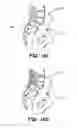 Fig. 26 - Method and apparatus for joint fusion