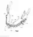 Fig. 13 - Orthognathic implant and methods of use