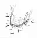 Fig. 18 - Orthognathic implant and methods of use