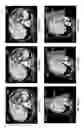 Fig. 09 - Computer-aided planning of liver surgery