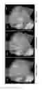 Fig. 17 - Computer-aided planning of liver surgery