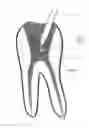 Fig. 07 - Methods and Devices for Treating Root Canals of Teeth