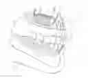 Fig. 01 - METHOD FOR MAXILLARY SINUS FLOOR ELEVATION