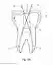 Fig. 07 - A METHOD AND SYSTEM FOR THE MANUFACTURING OF AN ORAL TEMPLATE FROM A 3D DIGITAL DATA