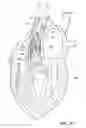 Fig. 14 - Collapsible valve having paravalvular leak protection