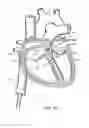Fig. 04 - Adjustable implant system