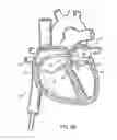Fig. 05 - Adjustable implant system
