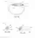 Fig. 15 - Adjustable implant system