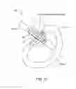 Fig. 36 - Adjustable implant system