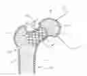 Fig. 01 - Femoral neck support structure, system, and method of use