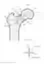Fig. 17 - Femoral neck support structure, system, and method of use