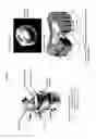 Fig. 02 - Intervertebral disc implant