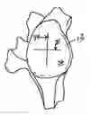 Fig. 01 - GLENOID COMPONENT INSTALLATION PROCEDURE AND TOOLING FOR SHOULDER ARTHROPLASTY