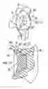 Fig. 07 - GLENOID COMPONENT INSTALLATION PROCEDURE AND TOOLING FOR SHOULDER ARTHROPLASTY