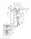 Fig. 01 - Transatrial patient temperature control catheter