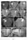 Fig. 02 - Delivery of a therapeutic agent to the cerebral cortex by administering a viral vector by convection enhanced diffusion into the white matter of the brain